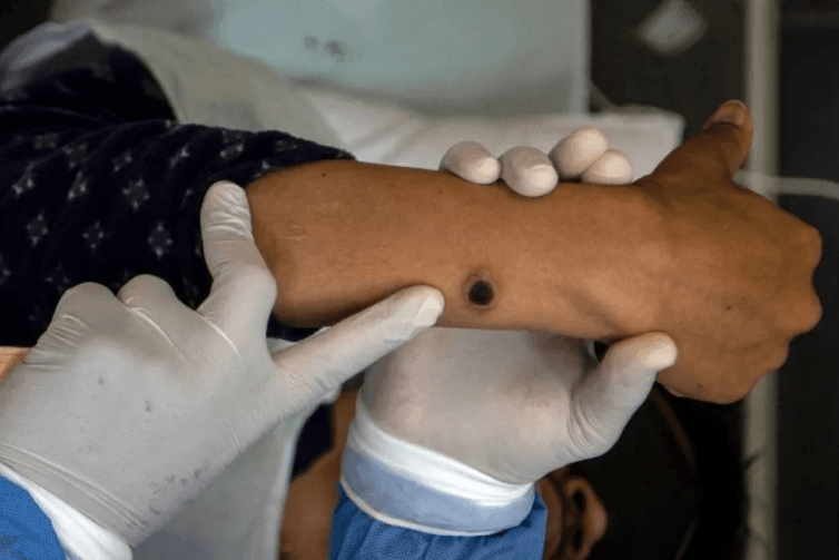 Brasil registra 88 casos de Mpox em 2026; saiba como evitar a doença