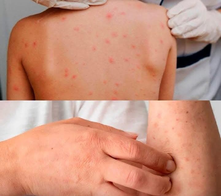 Castanhal emite alerta epidemiológico para o aumento de casos de sarna