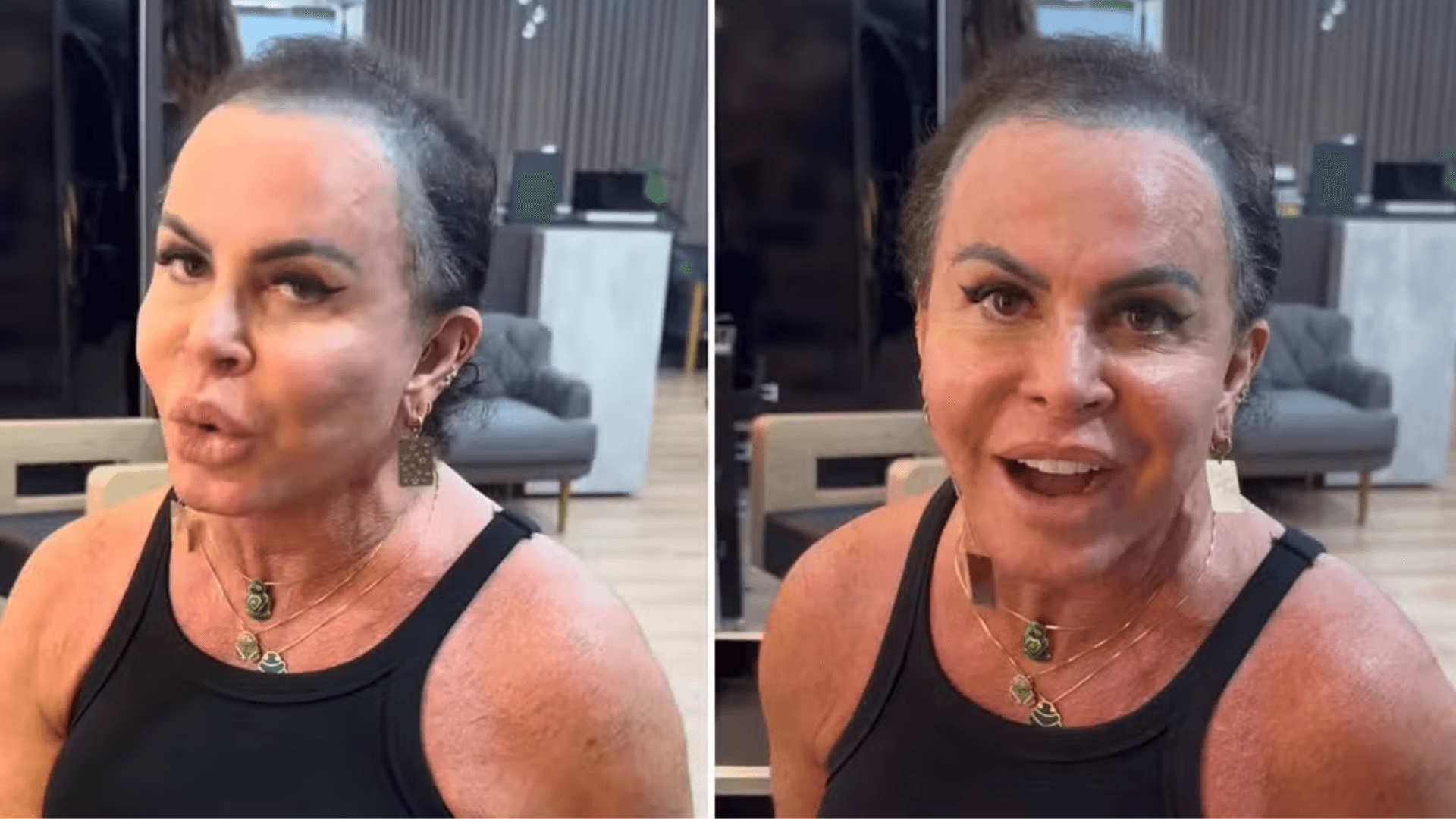 Em tratamento de alopecia, Gretchen surge sem prótese capilar na web