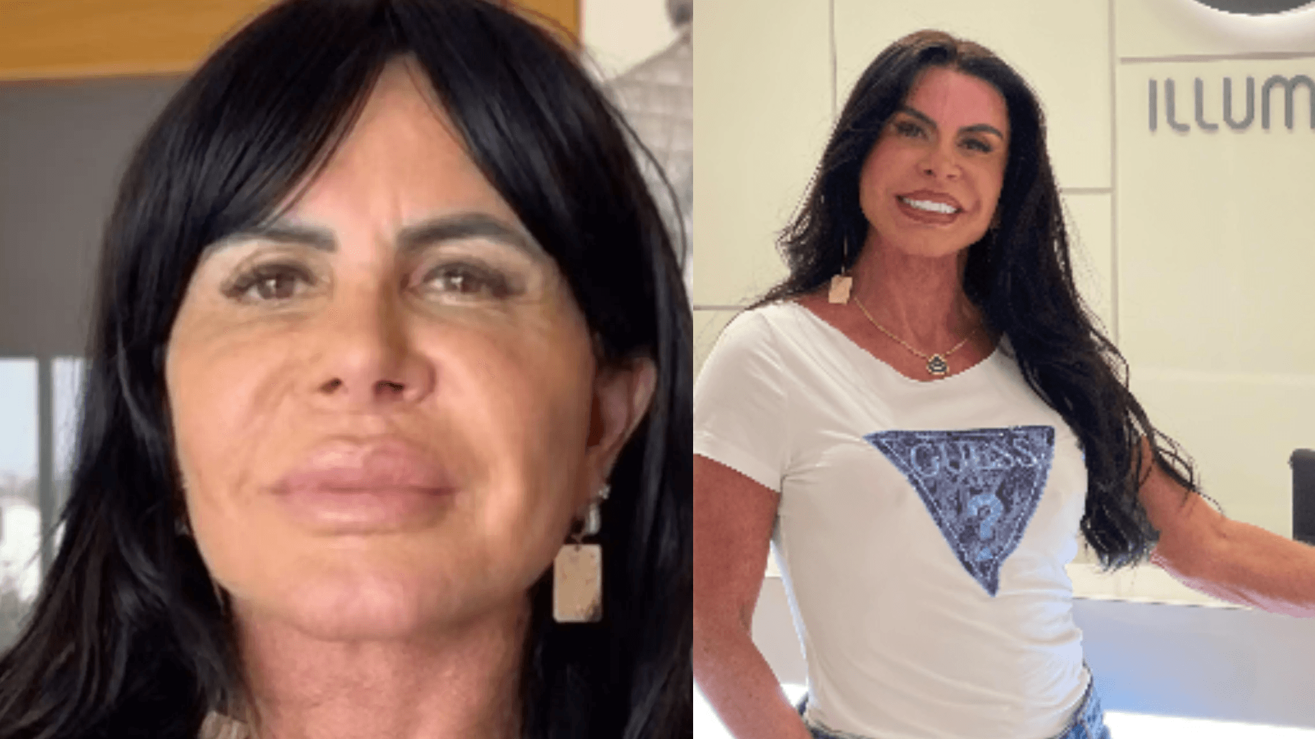 Gretchen revela nova harmonização facial e fala sobre procedimentos estéticos realizados